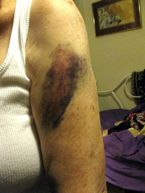 Bruises Arm.jpg